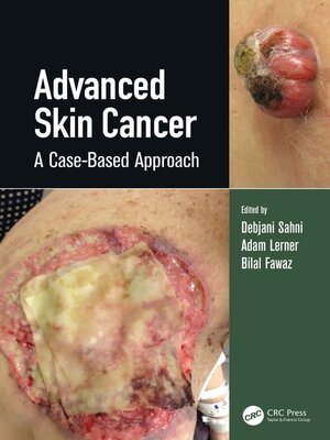 cover image of Advanced Skin Cancer